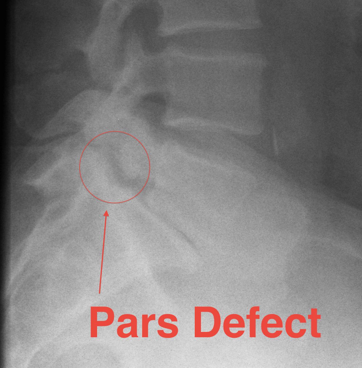 Pars Defect Lateral Xray